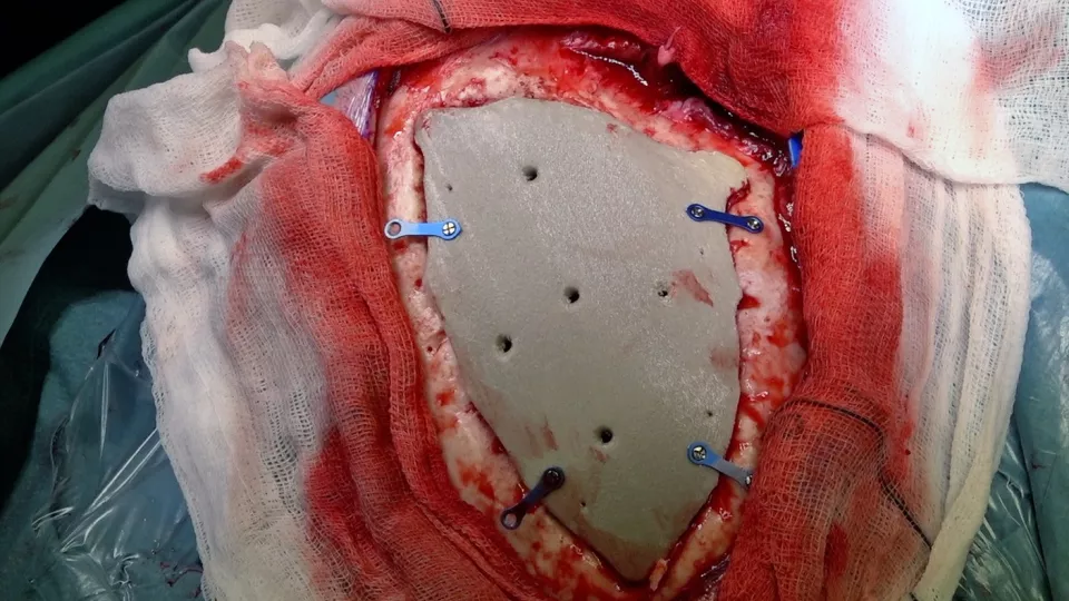 Image from an operation. A 3D skull implant in place. Photograph. 