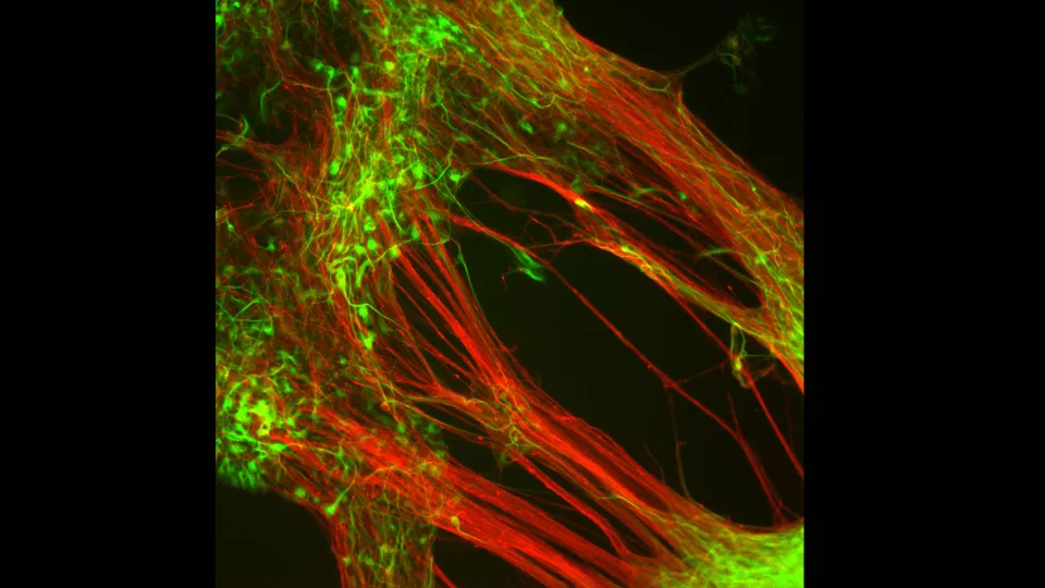 Dopamine-producing neurons that researchers from Lund University have grown in the laboratory from human embryonic stem cells (Photo: Agneta Kirby)