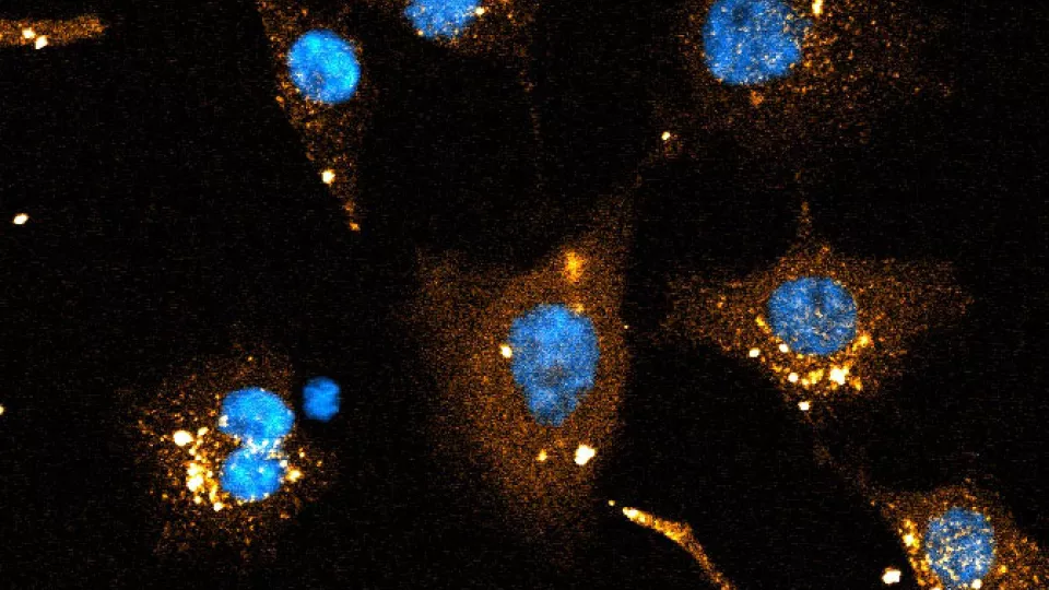 siRNA delivered to cervical cancer cells. Cell nuclei in blue. Double-stranded RNA molecules in orange. Diffuse orange signal around nucleus are RNA molecules reaching the cytosol. Picture by Hampus Hedlund.